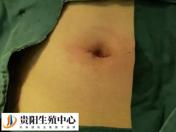 单孔腹腔镜手术只有一个切口